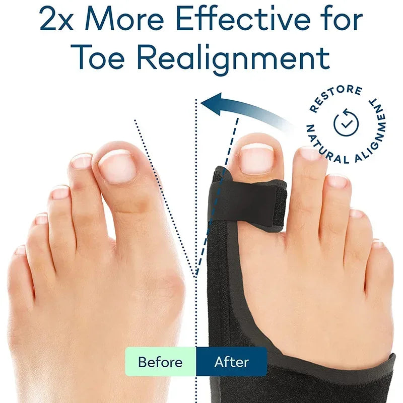 Orthopedic Bunion Splint Corrector for Hallux Valgus Pain Relief